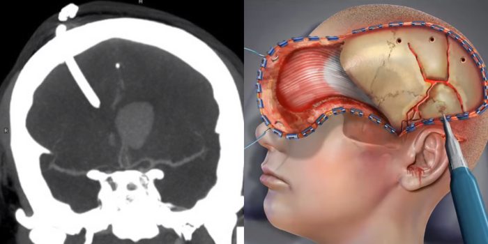 can paintball guns kill brain injury